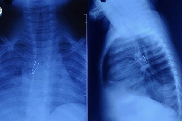 Cấp cứu thành công bé 9 tháng tuổi bị bóng đèn LED mắc kẹt trong phế quản 